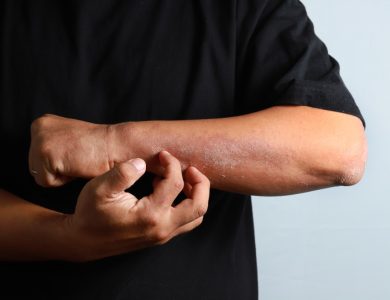 Eczema-types-and-treatments