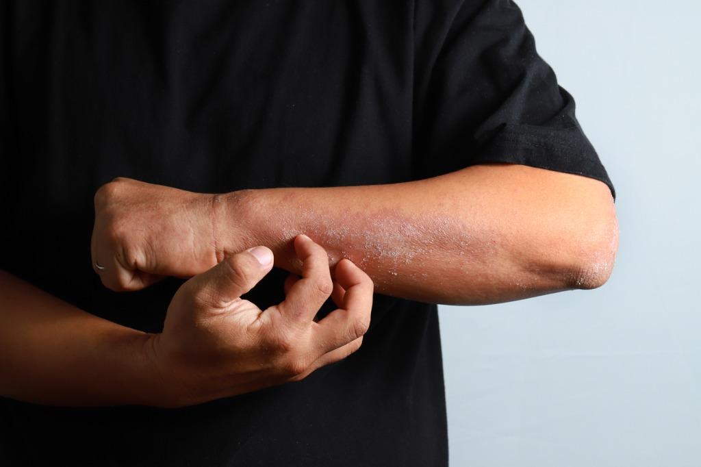 Eczema-types-and-treatments