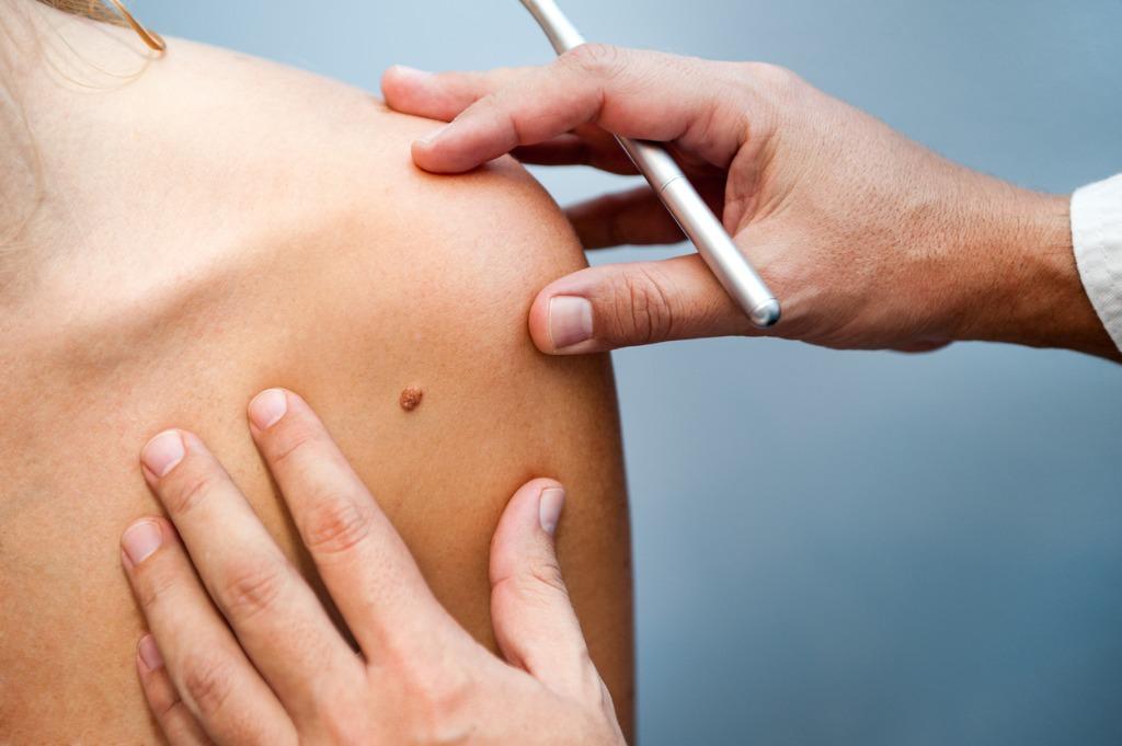 our-abcdefghi-melanoma-algorithm-to-diagnose-early-melanomas
