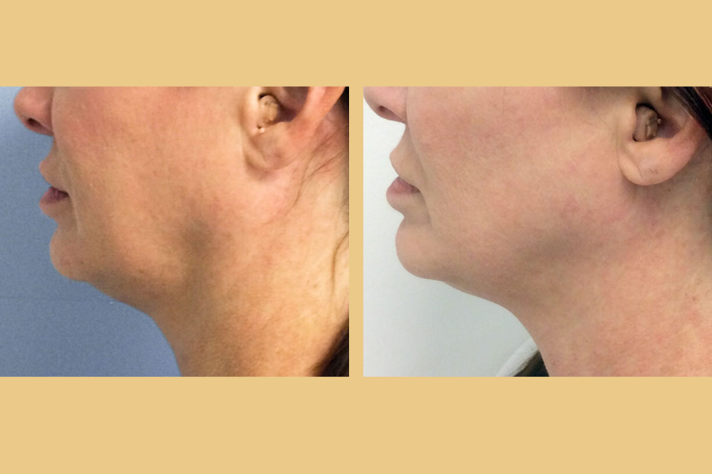 Skin-tightening-with-ultherapy