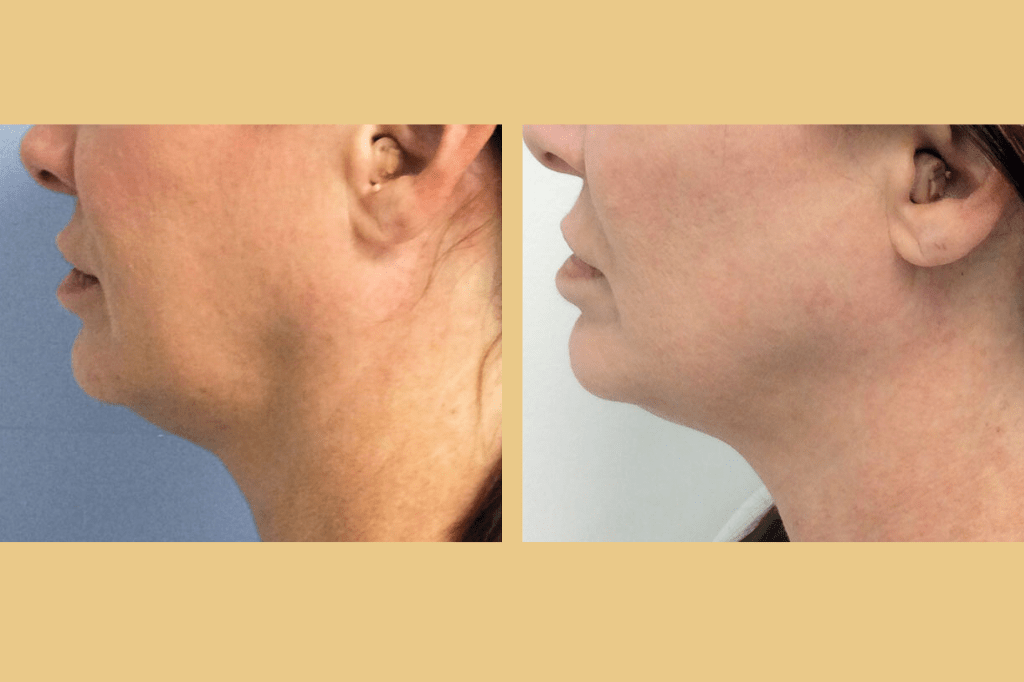 skin-tightening-with-ultherapy