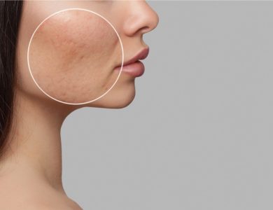 Acne-scar-laser-treatment-the-path-to-smooth-skin