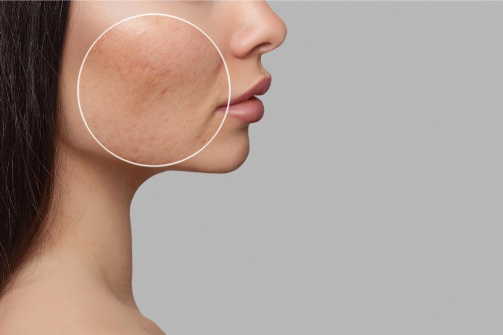 acne-scar-laser-treatment-the-path-to-smooth-skin