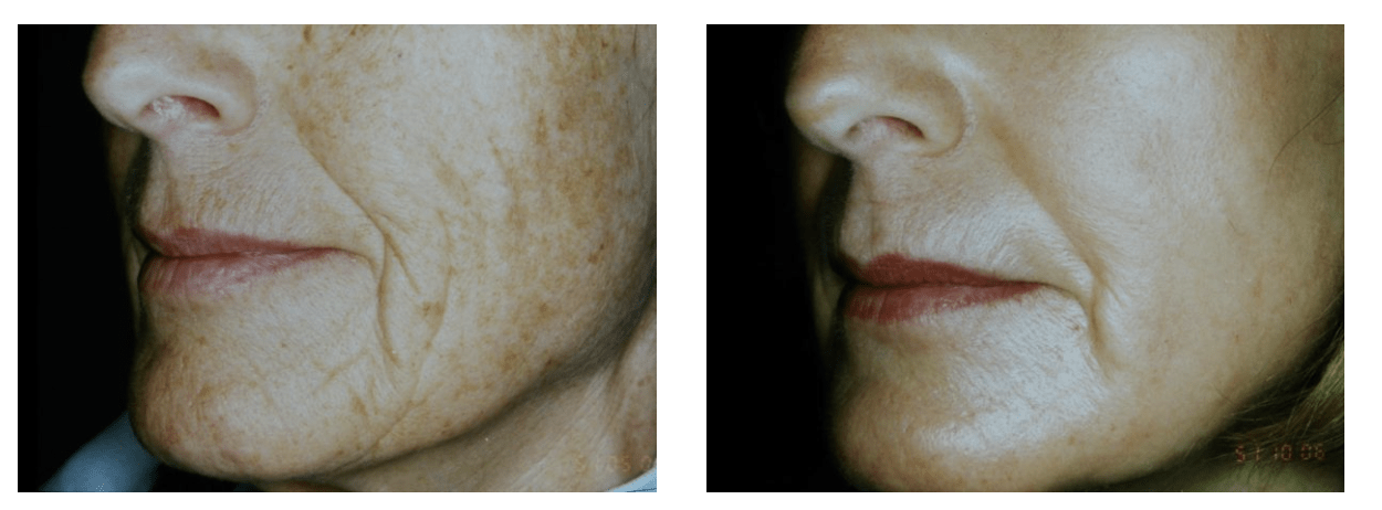 CO2 Laser Skin Resurfacing Near Tampa, FL