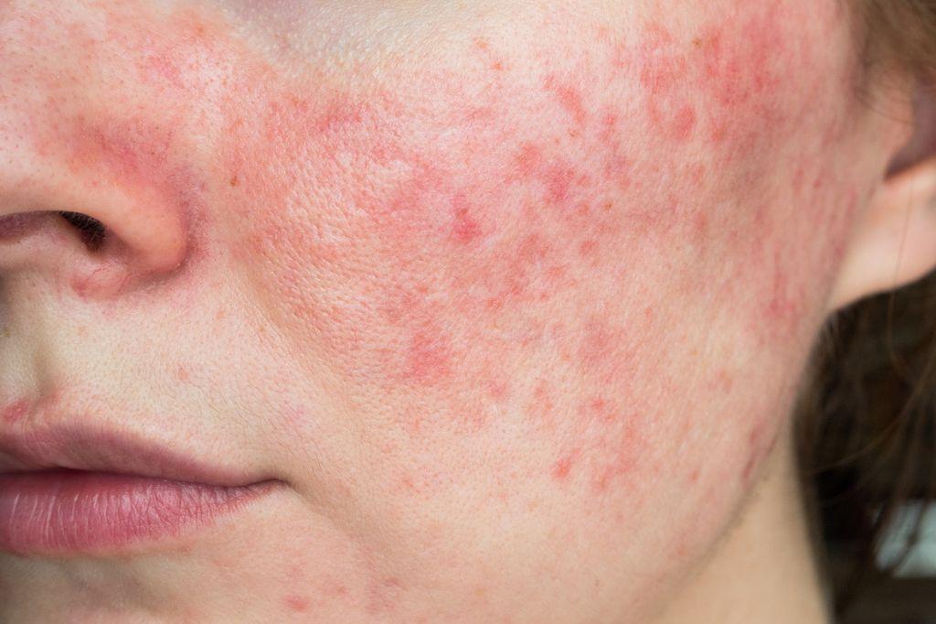 Top-rosacea-treatments-expert-recommendations