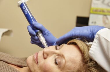 Skinpen-microneedling-to-achieve-youthful-looking-skin