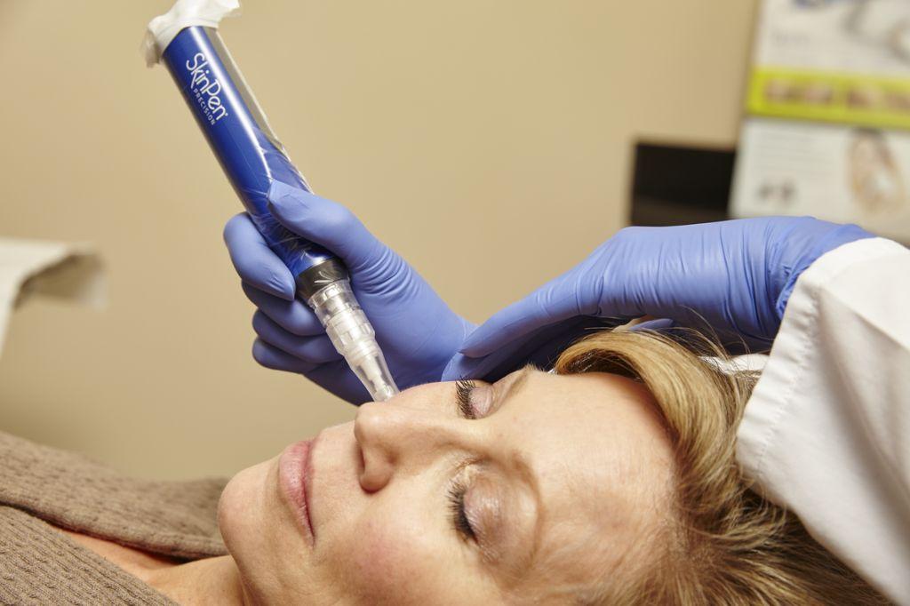 Skinpen-microneedling-to-achieve-youthful-looking-skin