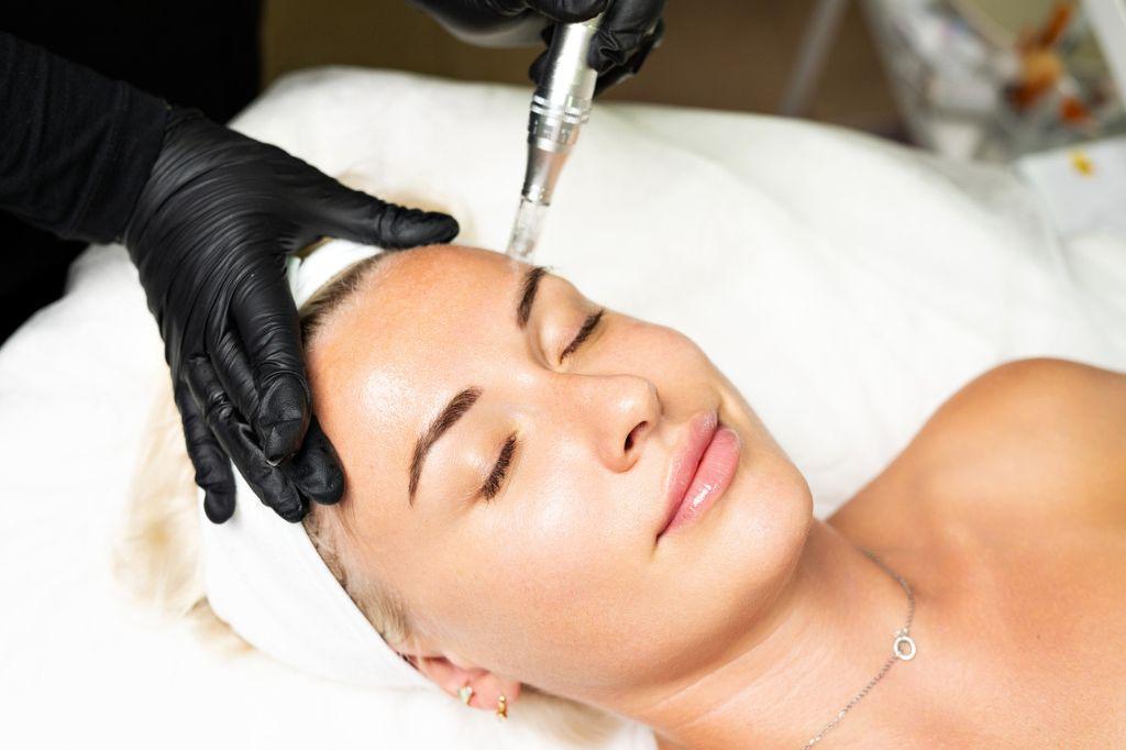 the-transformative-benefits-of-microneedling-with-prp
