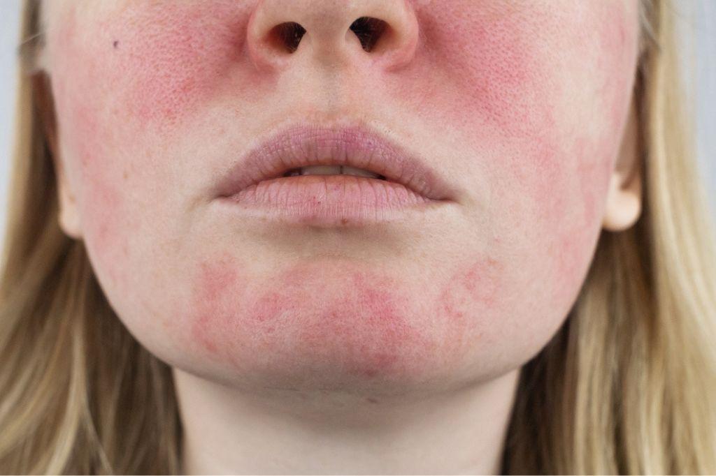 7 Reasons Why Your Face Is Always Red