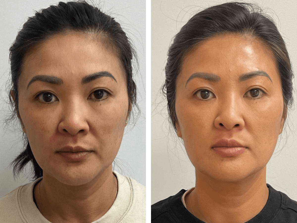 injectables before and after