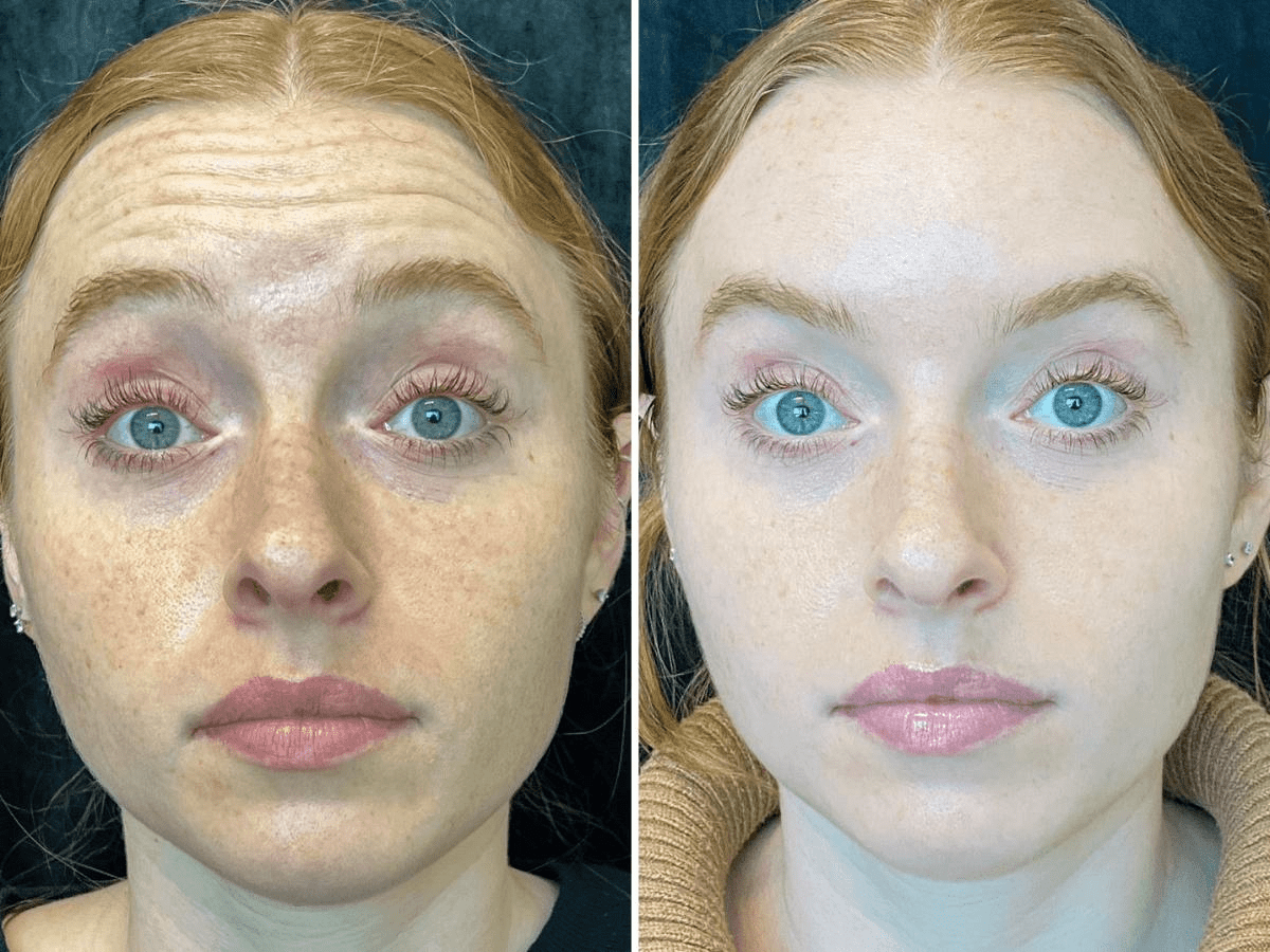 injectables before and after