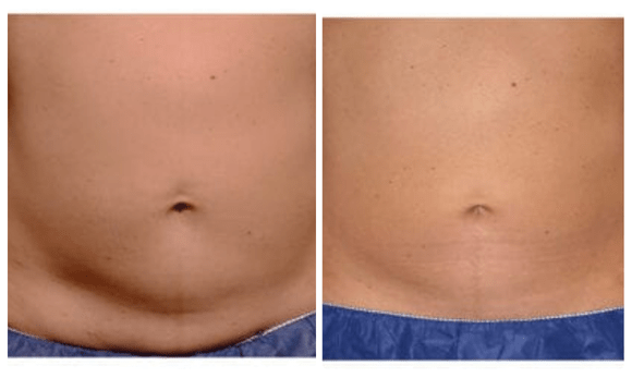 coolsculpt before and after