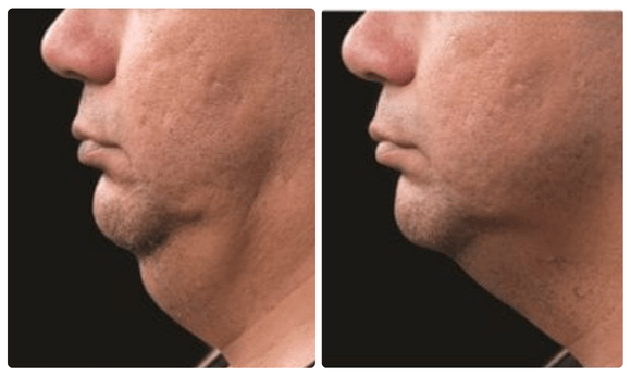 coolsculpt before and after