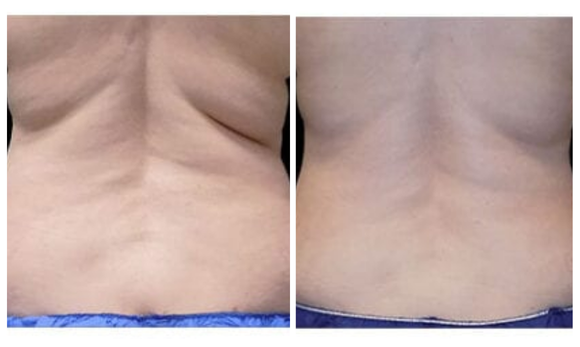 coolsculpt before and after