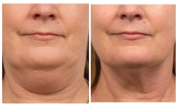 coolsculpt mini before and after