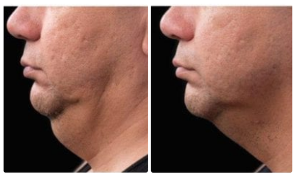 coolsculpt mini before and after