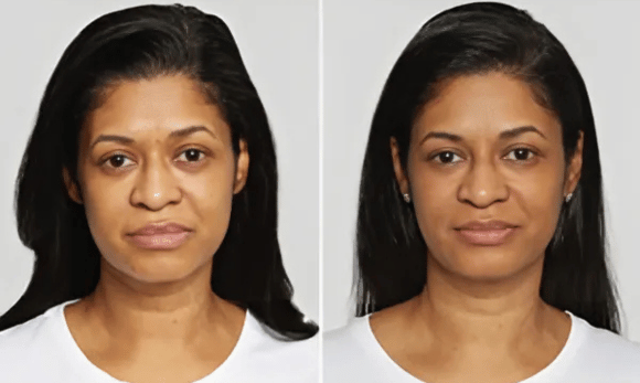 sculptra before and after