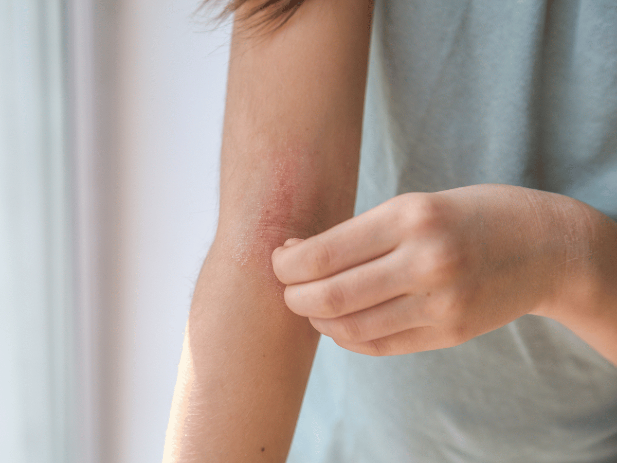 eczema on arm
