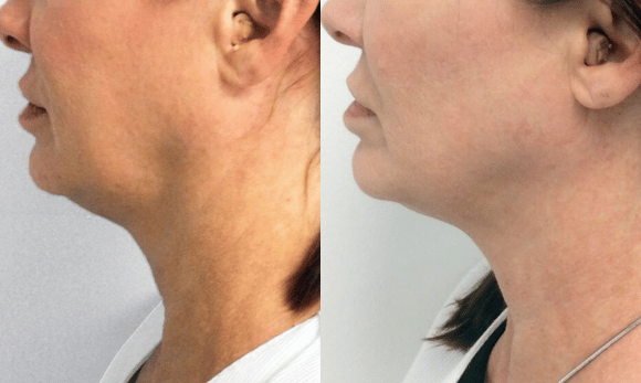 before and after Ultherapy