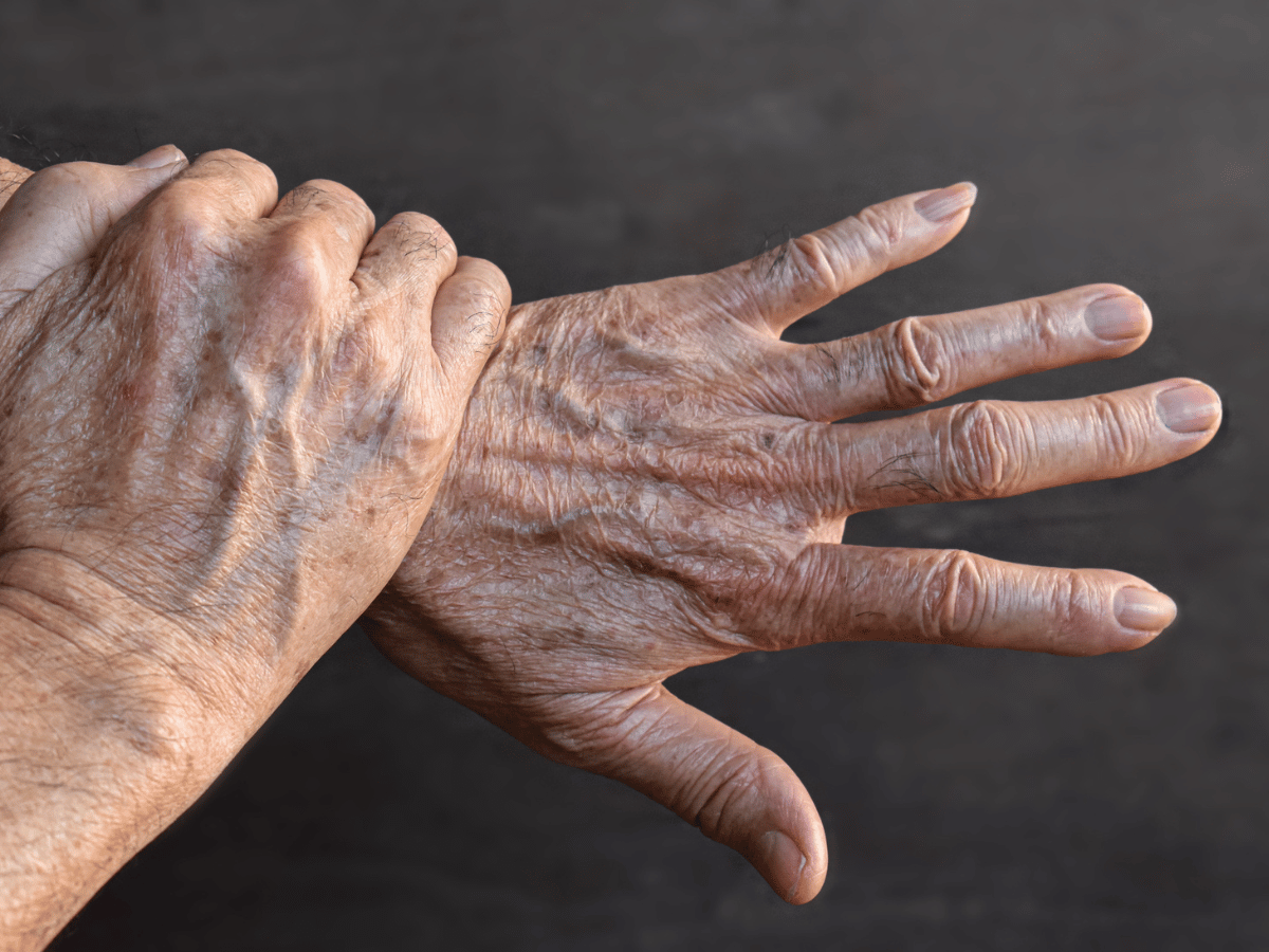 aging skin on hands