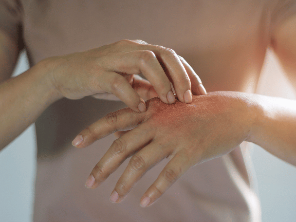 itching hands