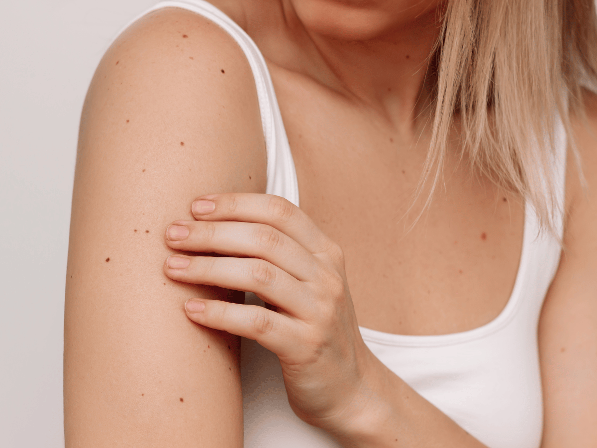 birthmarks on arm