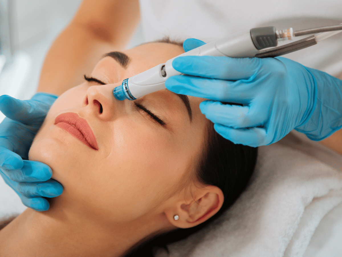 Microneedling procedure