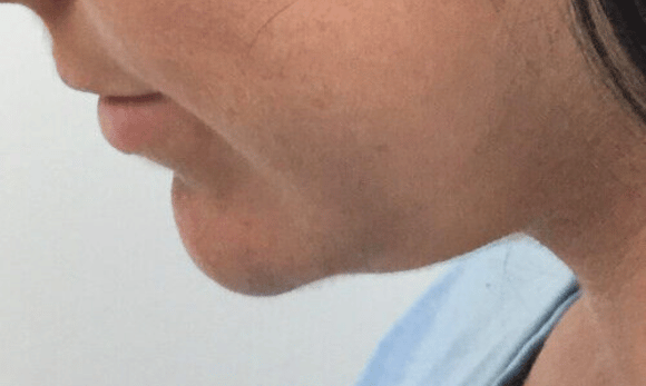 after kybella