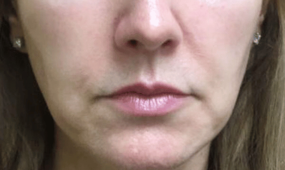 jaw after kybella
