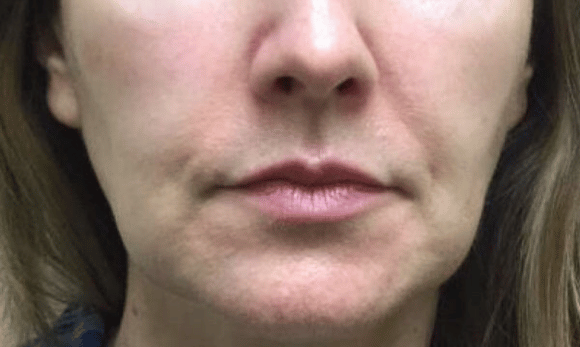 jaw before kybella