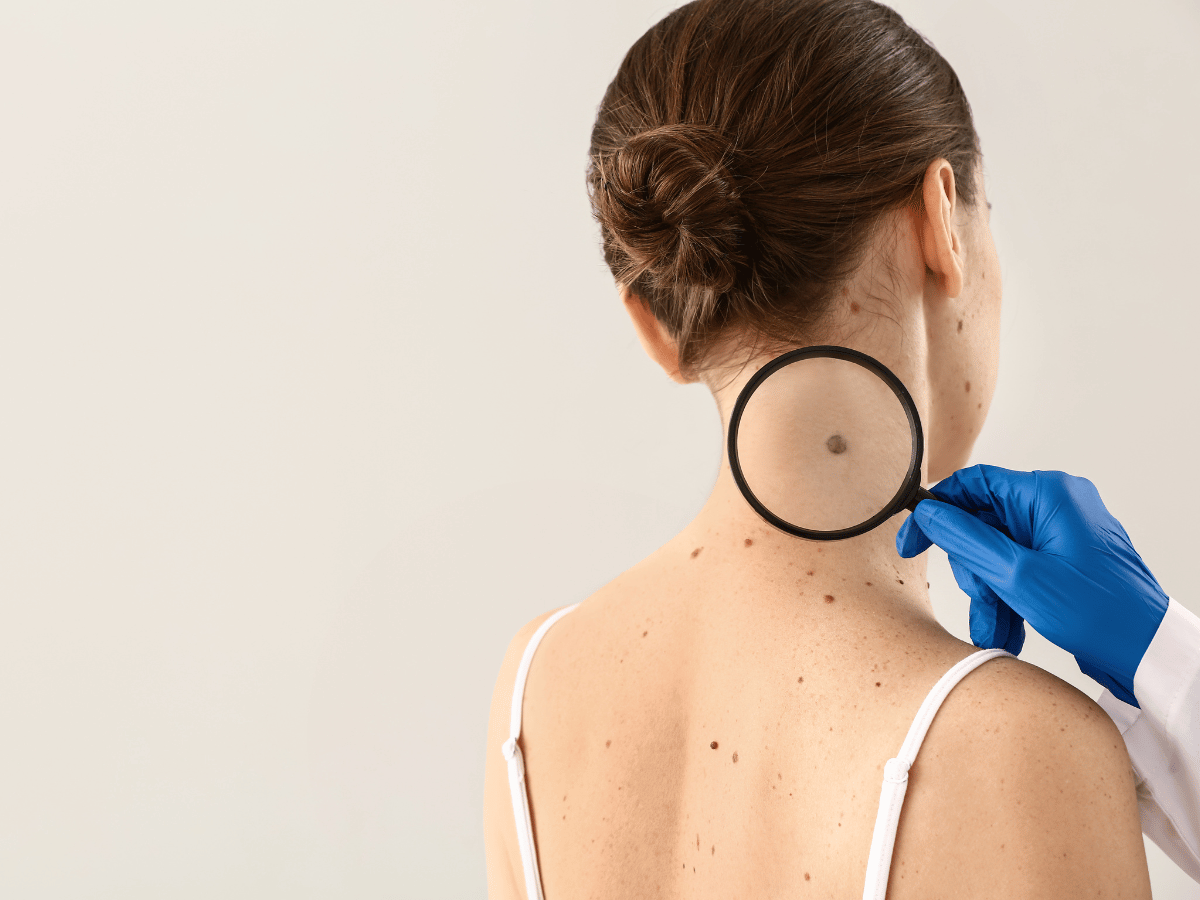 skin check for melanoma