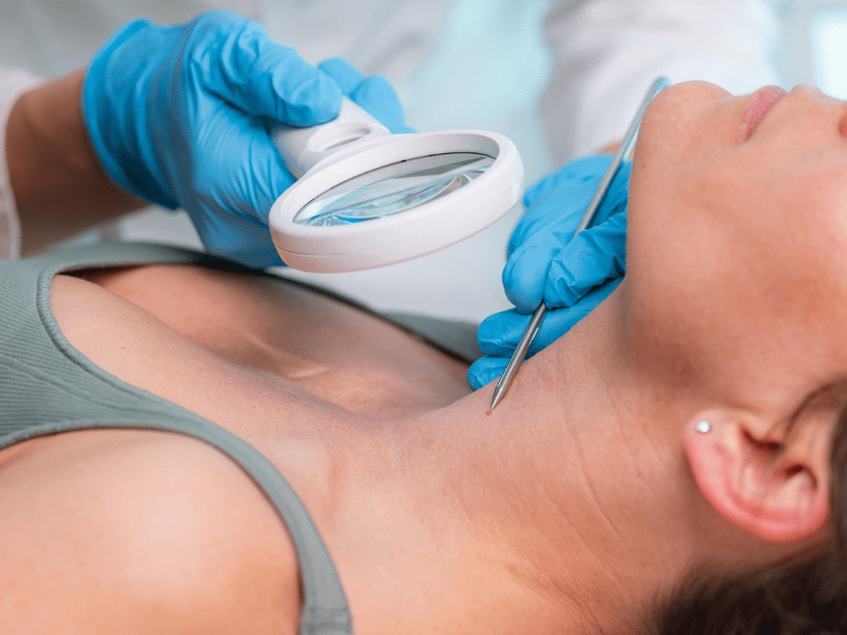 surgical mole removal