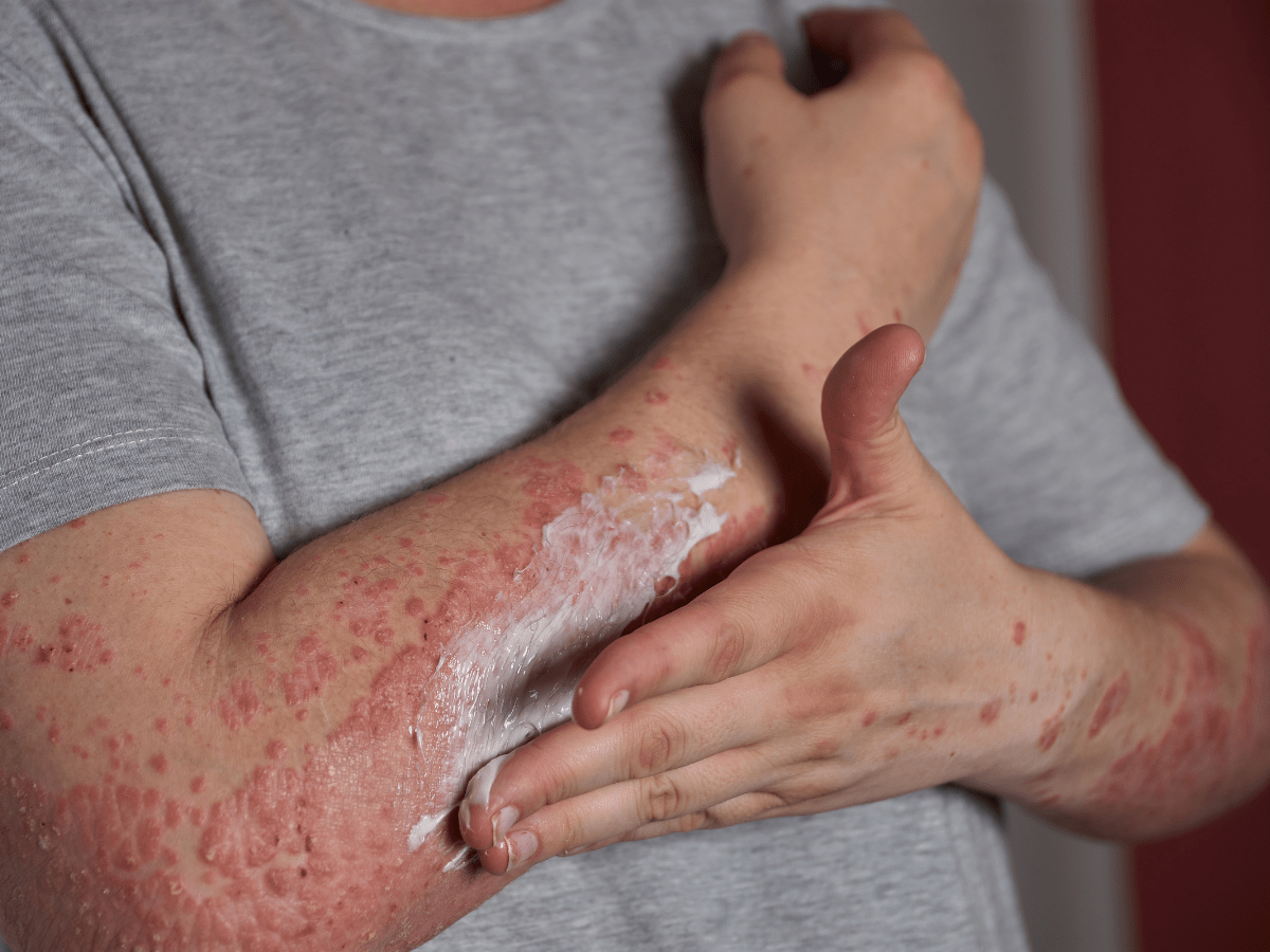 application of cream