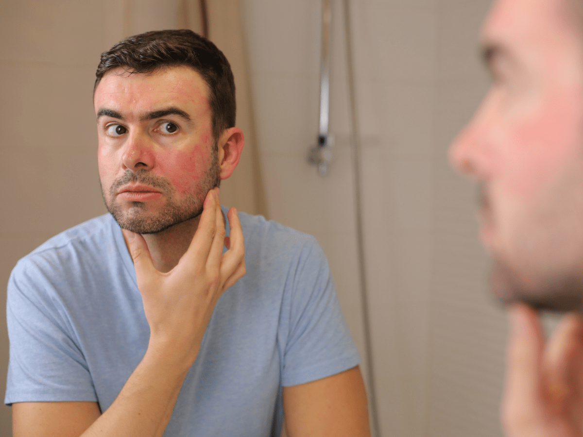 male with rash on his face