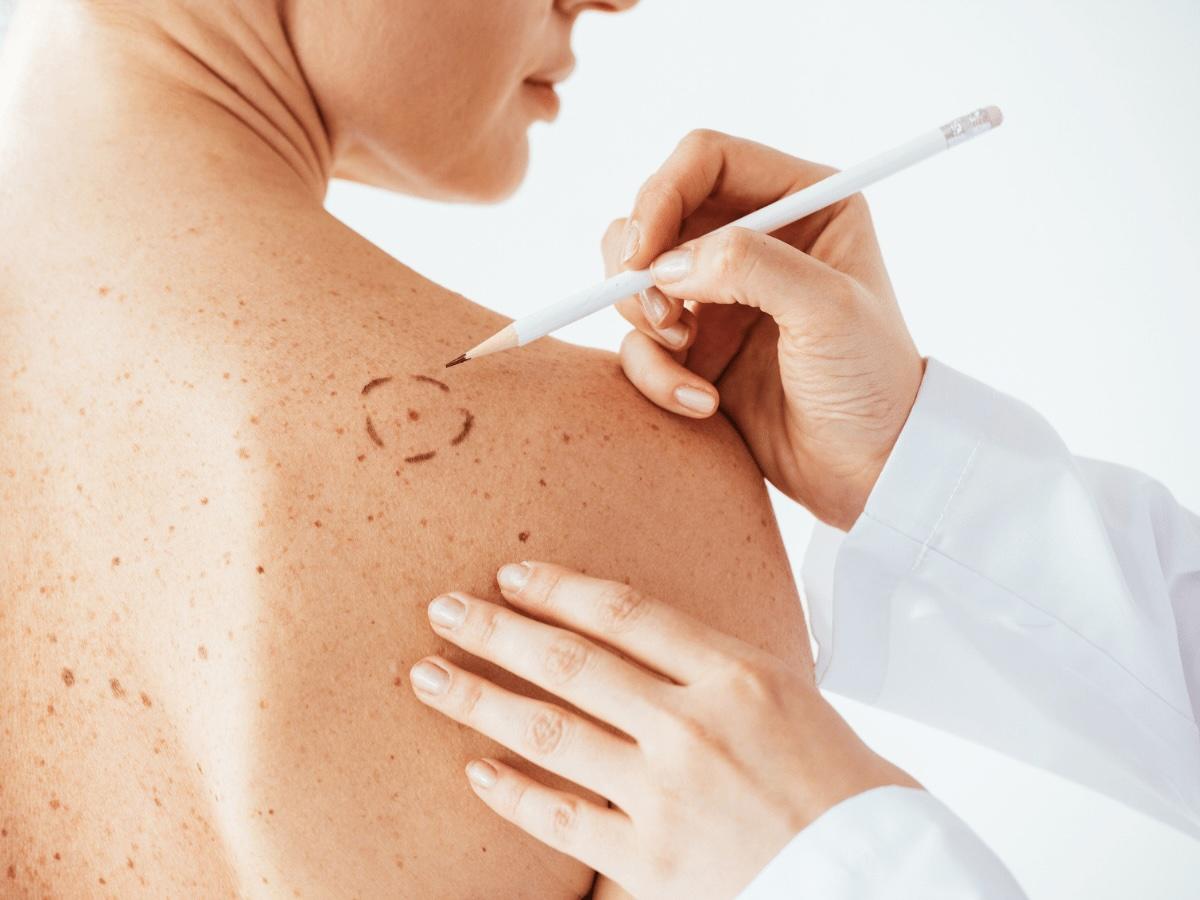 doctor drawing margins around mole on patient's back