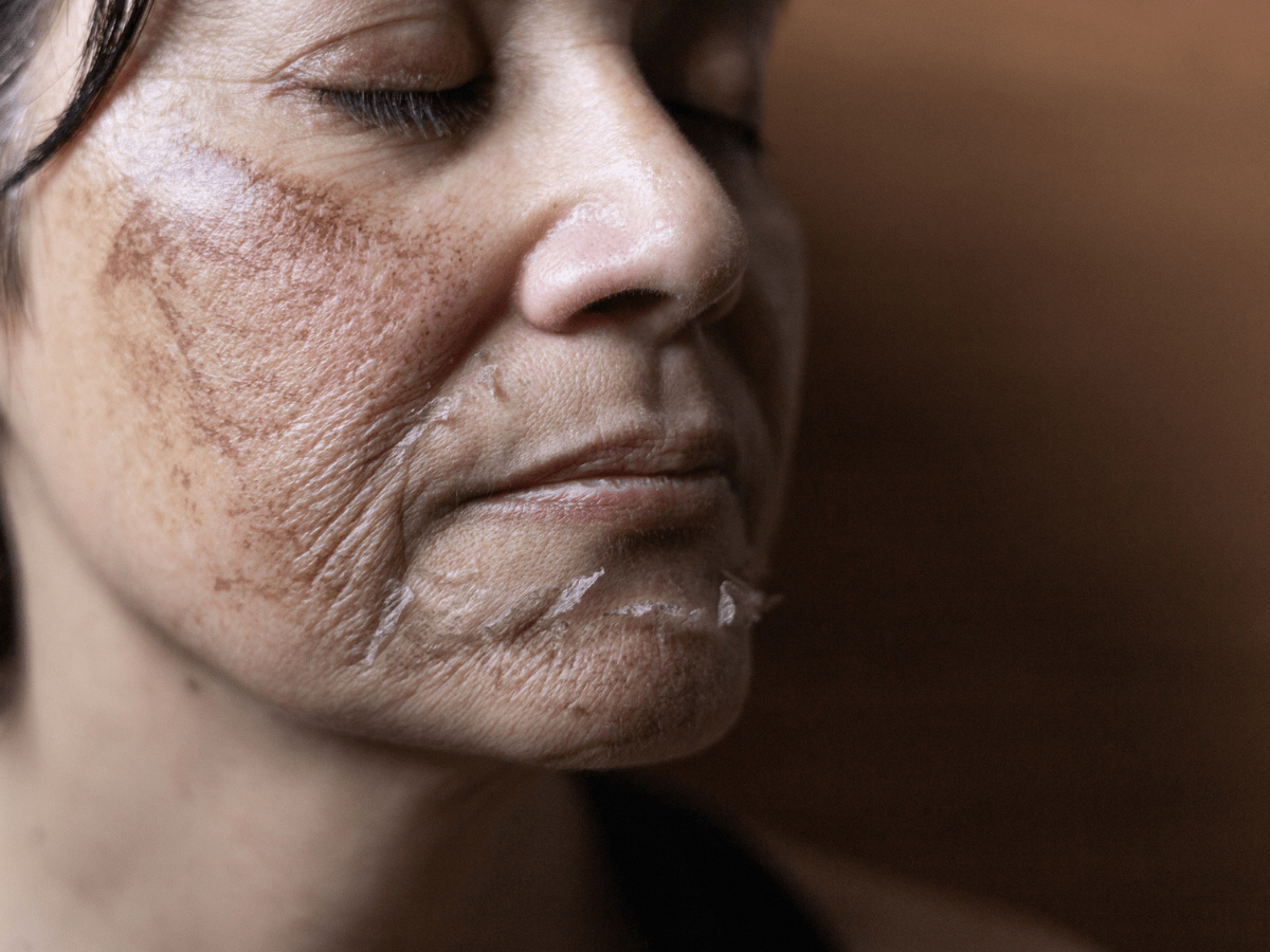 face after chemical peel