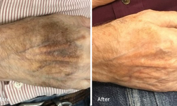 before and after photos of LED therapy on hands