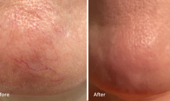 before and after photos of LED therapy on nose